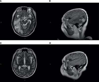 Reirradiation of Whole Brain for Recurrent Brain Metastases: A Case Report of Lung Cancer With 12-Year Survival